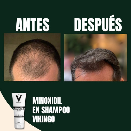 Shampoo con Minoxidil para fortalecer el cabello | Daily Shampoo Vikingo
